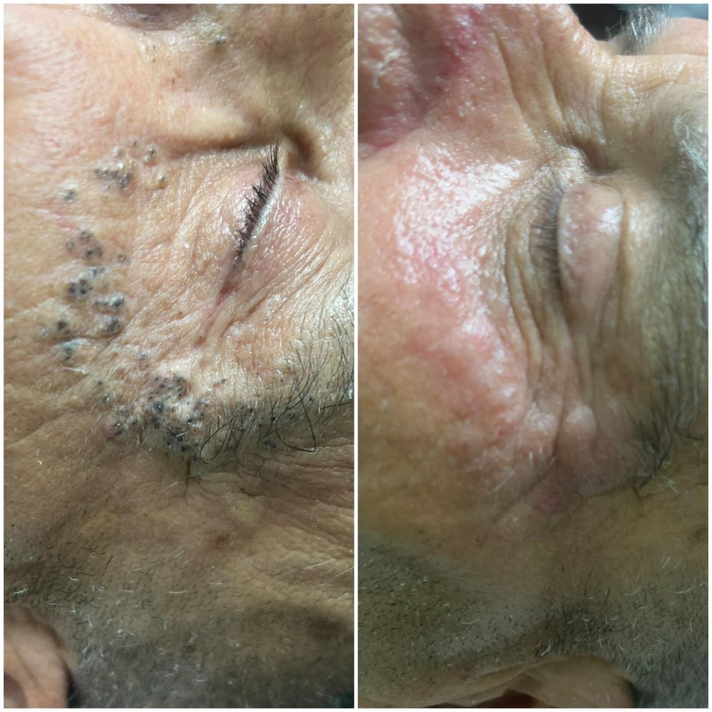 Antes y después de tratamiento facial