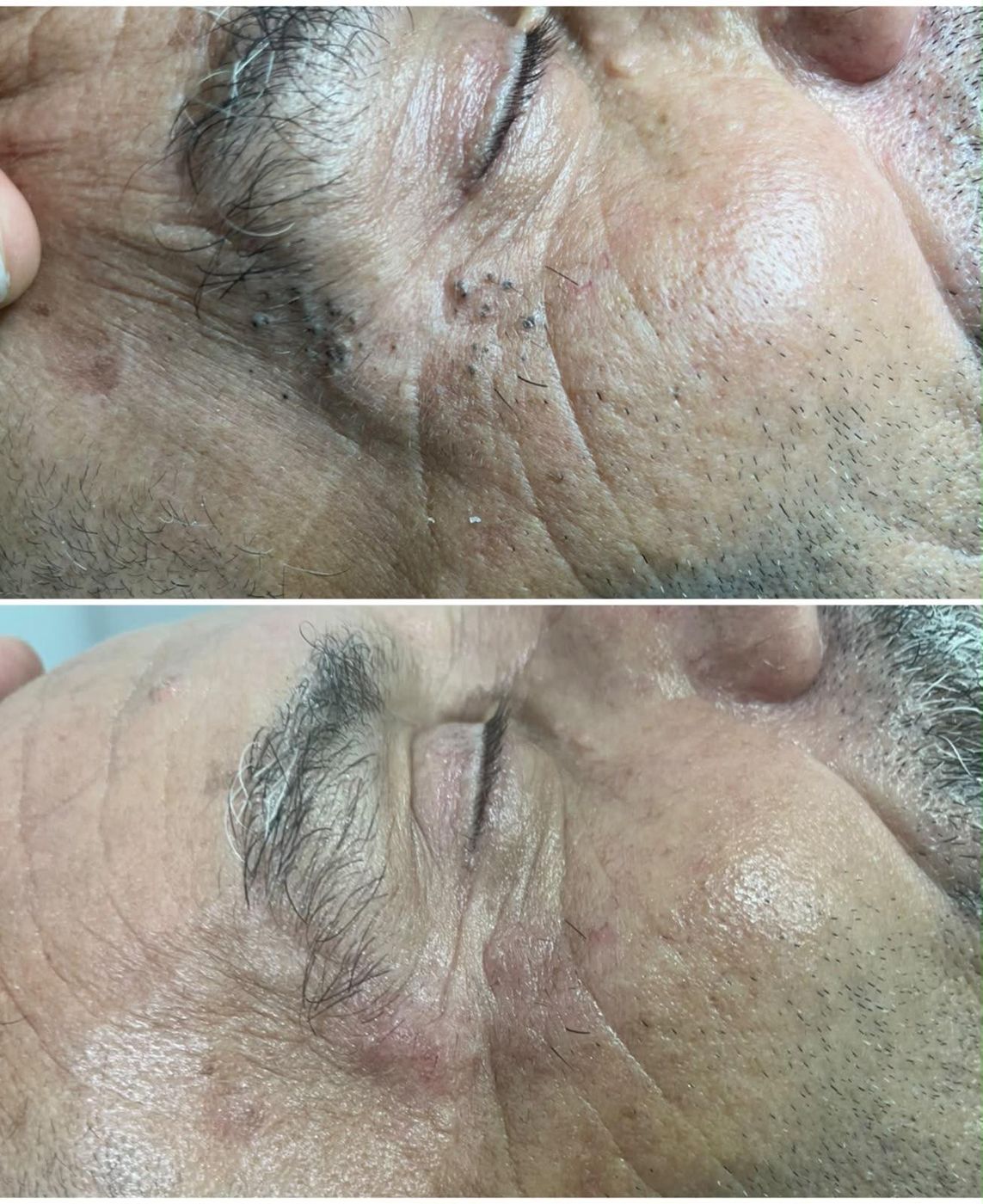 Antes y después de tratamiento facial